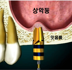 뼈이식